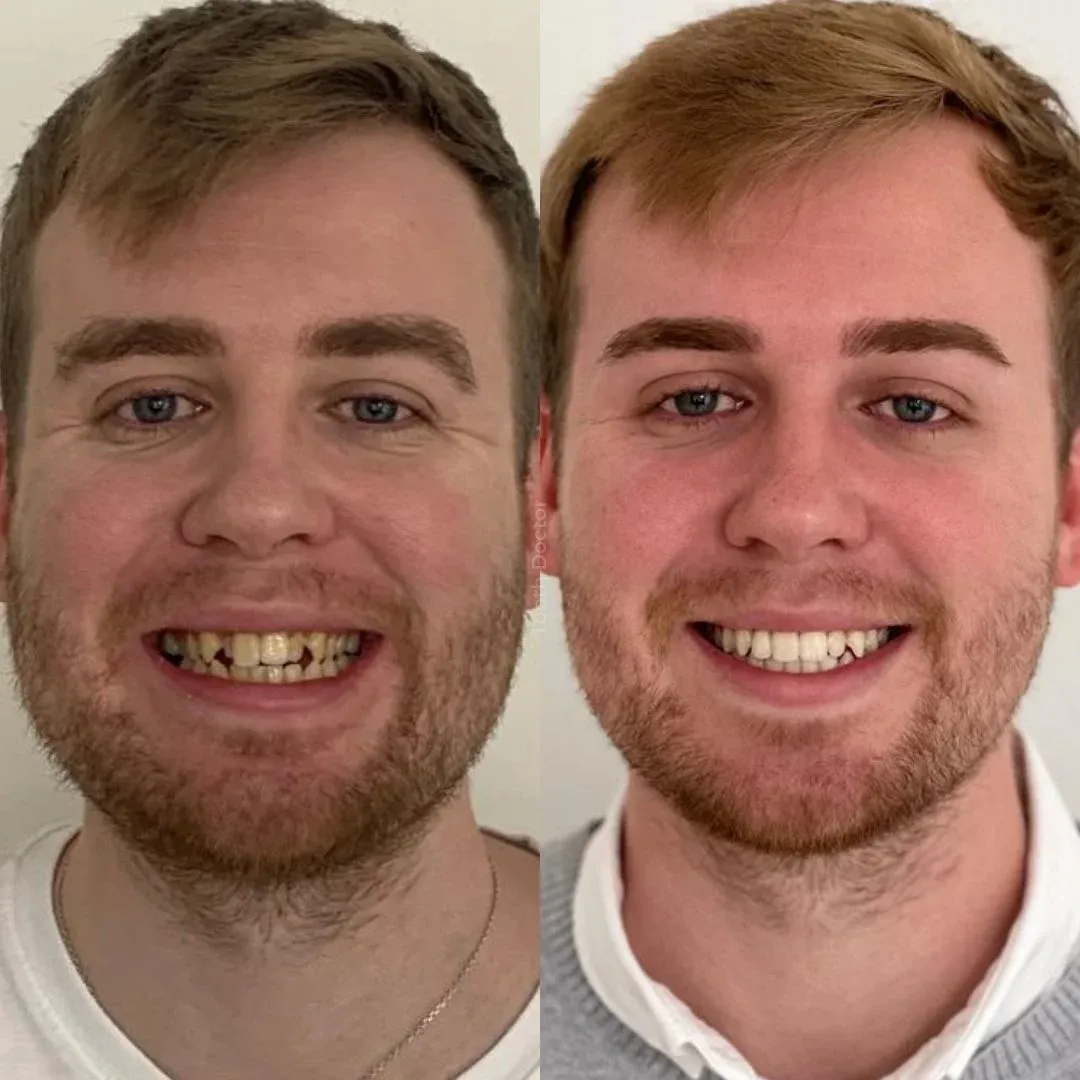 Before and after dental implant treatment with Gerard Skeffington